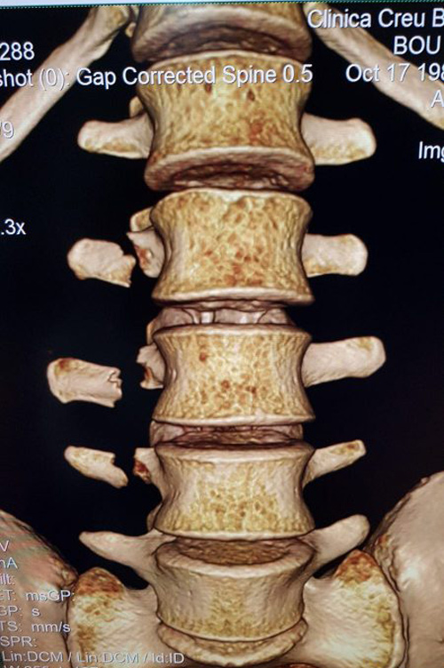 Fractura de las vértebras de Toni Bou tras su accidente en el Trial de Le Mans